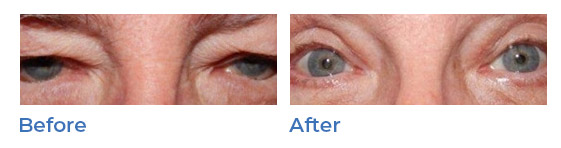 Lower eyelid surgery image 02