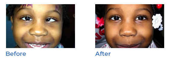 strabismus - before and after 02