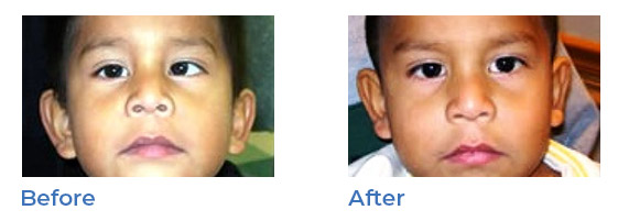 strabismus - before and after 03