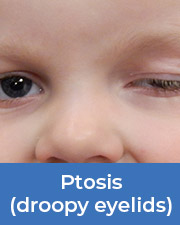 child with ptosis - droopy eyelids
