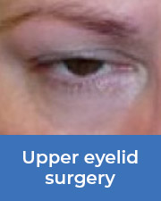 Close up on an eye that needs upper eyelid surgery
