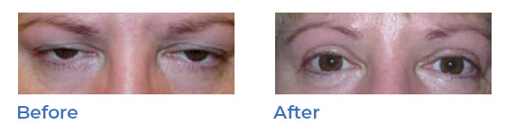 Blepharoplasty, or upper eyelid surgery, image 03