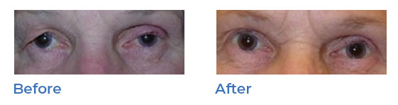 Blepharoplasty, or upper eyelid surgery, image 04