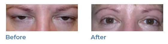 Blepharoplasty, or upper eyelid surgery, image 03