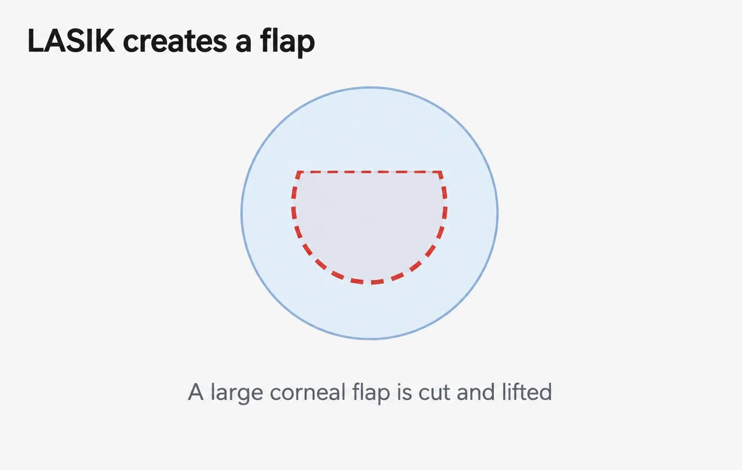 large-corneal-flap-img2